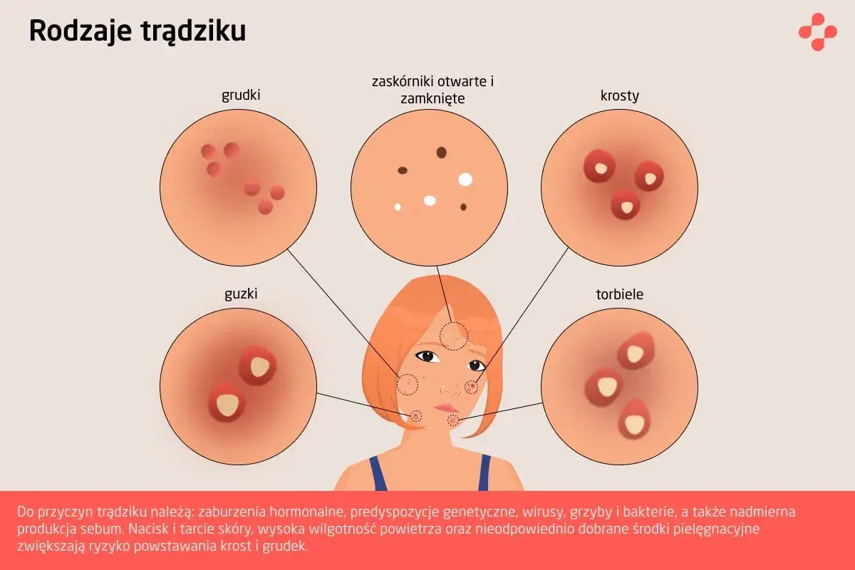 Rodzaje pryszczy na czole infografika