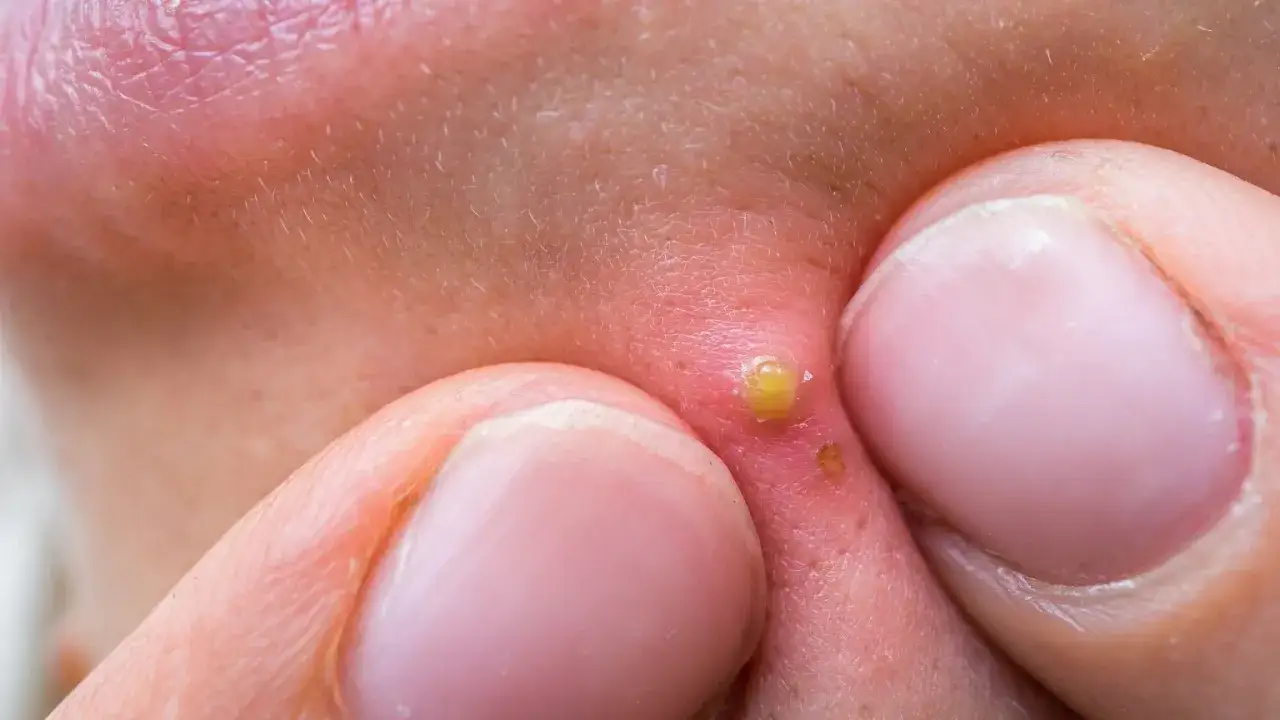 Nie wyciskaj pryszczy