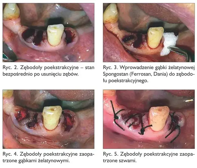 Pielęgnacja dziąsła po ekstrakcji zęba, skrzep krwi po usunięciu zęba