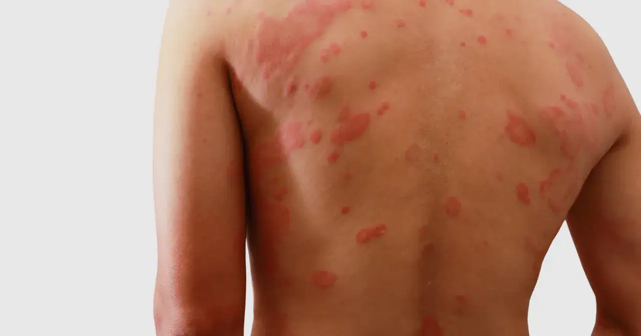 Plecy pokryte czerwonymi, swędzącymi bąblami, objaw uczulenia na antybiotyk.