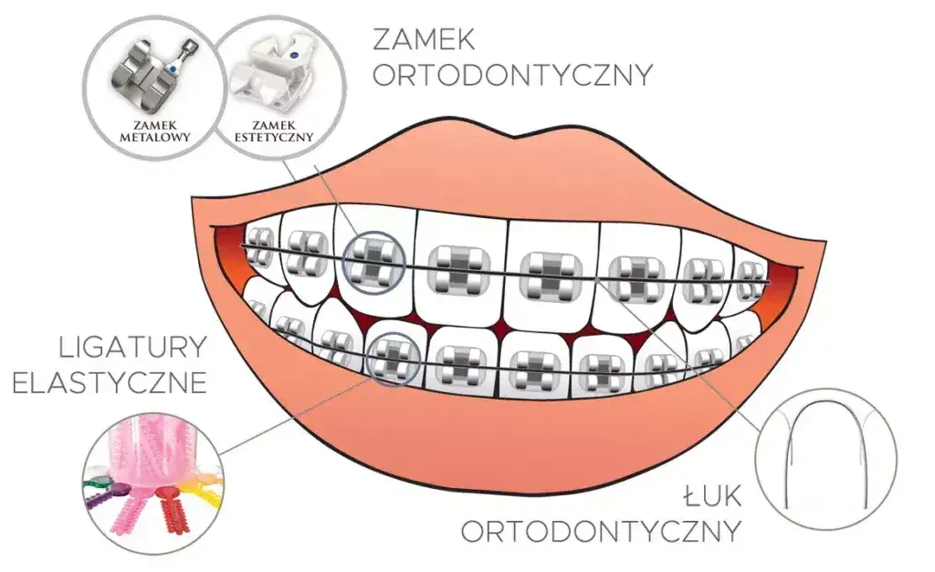 etapy leczenia ortodontycznego infografika