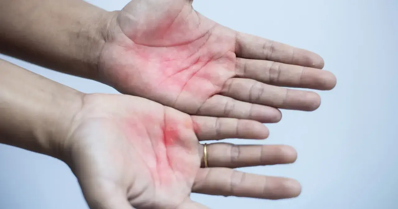 Dłonie z zaczerwienionymi, łuszczącymi się obszarami, które mogą być objawem plam na skórze od wątroby.