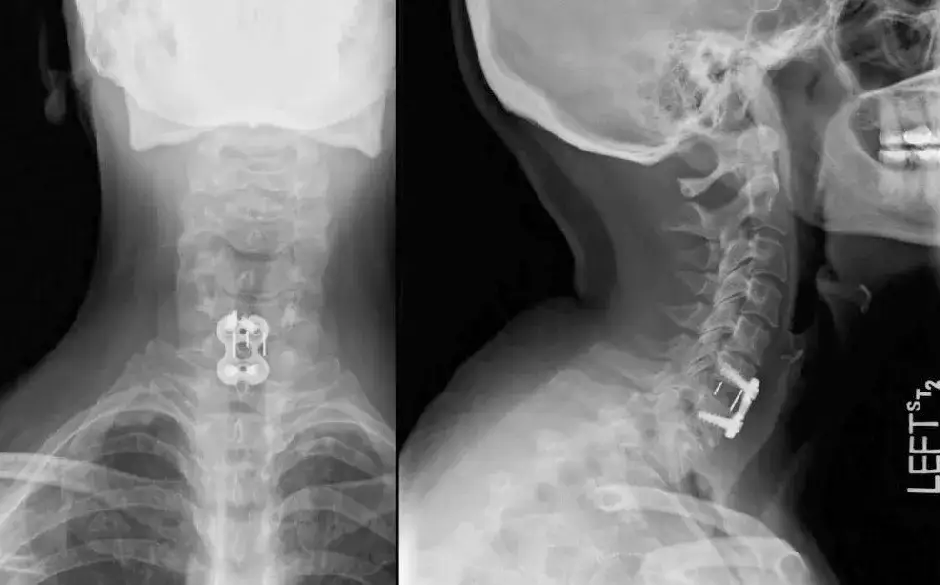 Zdjęcie Przepuklina kręgosłupa szyjnego C6-C7: objawy, diagnoza i leczenie