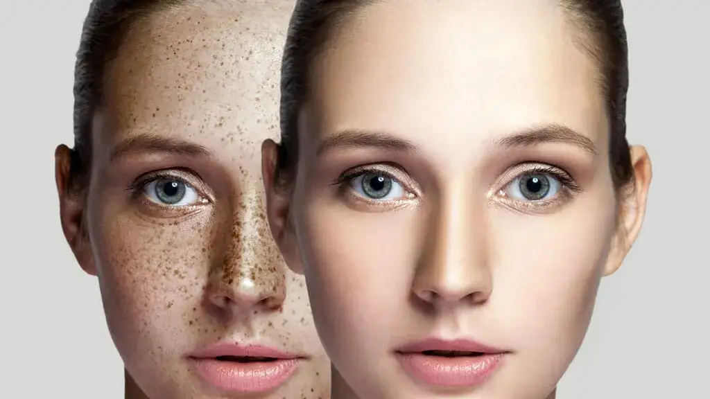 zabiegi kosmetyczne na przebarwienia twarzy