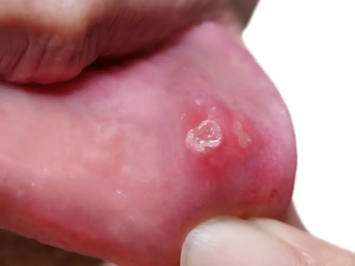 Spuchnięte usta u dziecka z widocznymi pęcherzykami i zaczerwienieniem.