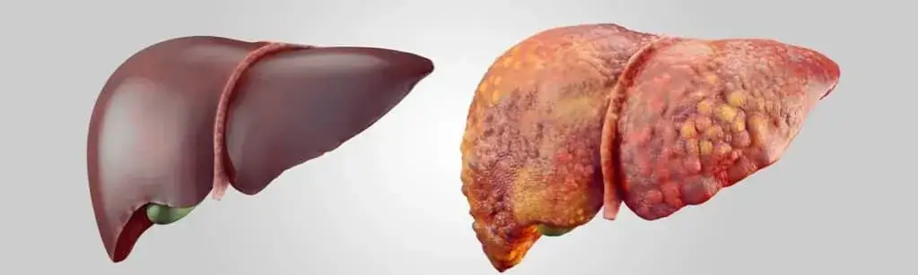 zdrowa wątroba a stłuszczenie wątroby porównanie
