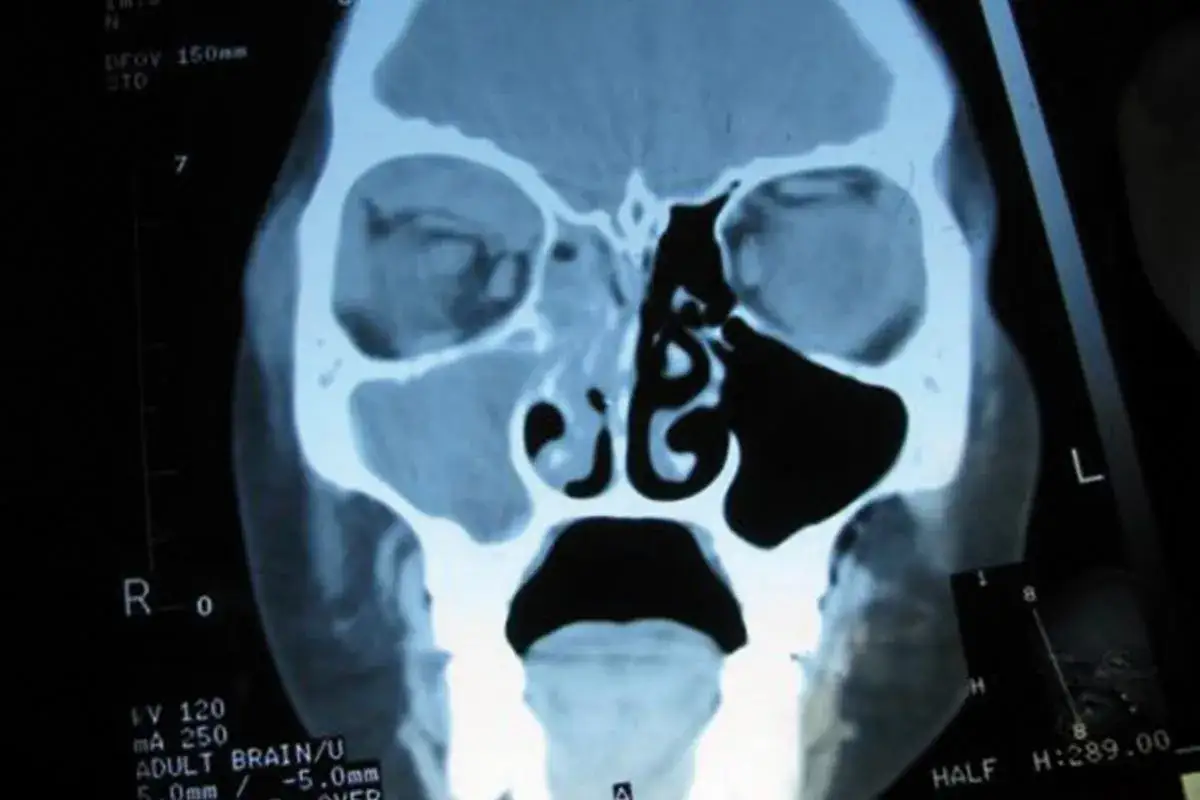 Zatoki klinowe anatomia