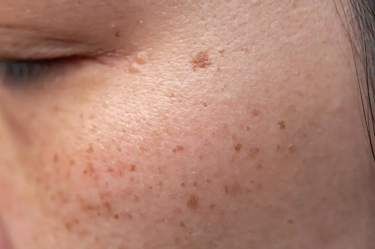 Zbliżenie na skórę twarzy z licznymi piegami i przebarwieniami. Widać drobne, brązowe plamki, które pojawiają się na skórze, co na kaszkę na twarzy.