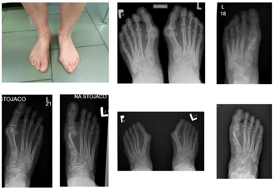 haluks stopa deformacja palucha koślawego