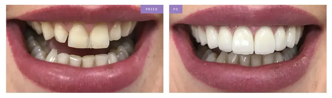 licówki porcelanowe przed i po