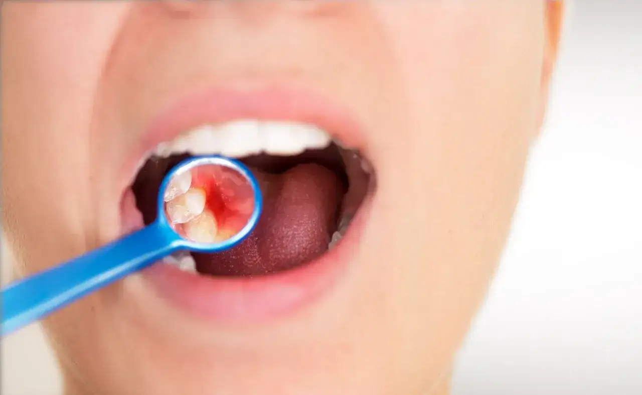 Widok jamy ustnej z lusterkiem dentystycznym, ukazującym ząb z zaczerwienionym dziąsłem i widoczną warstwą, która może być płytką nazębną.