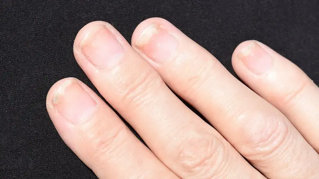 infekcje paznokci hybryda grzybica