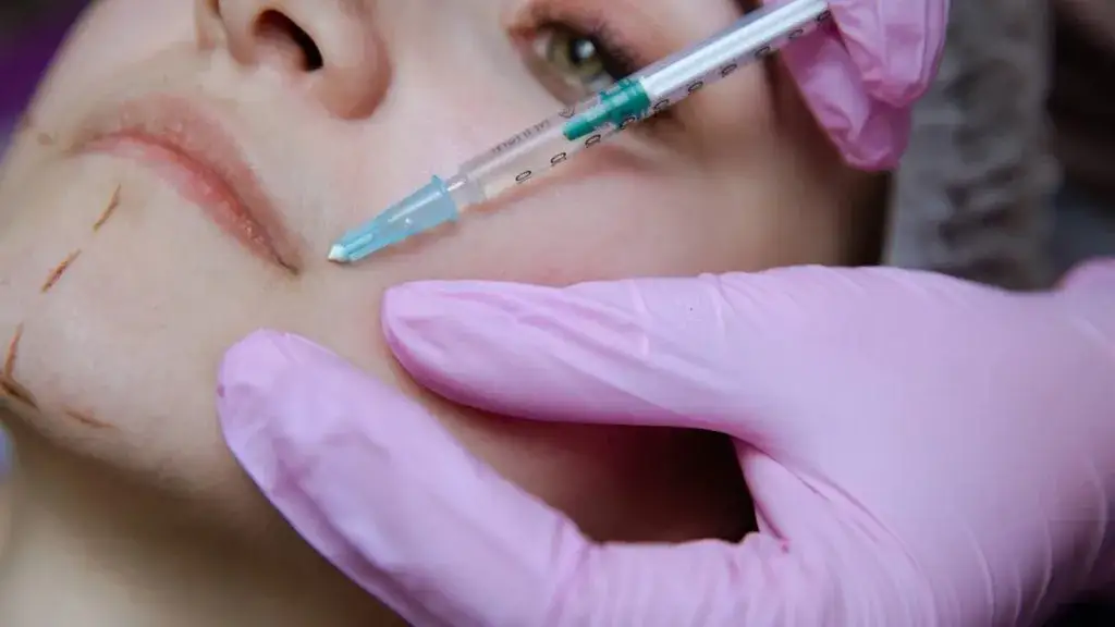 Zdjęcie Po jakim czasie widać efekty botoksu? Zaskakujące informacje o czasie działania