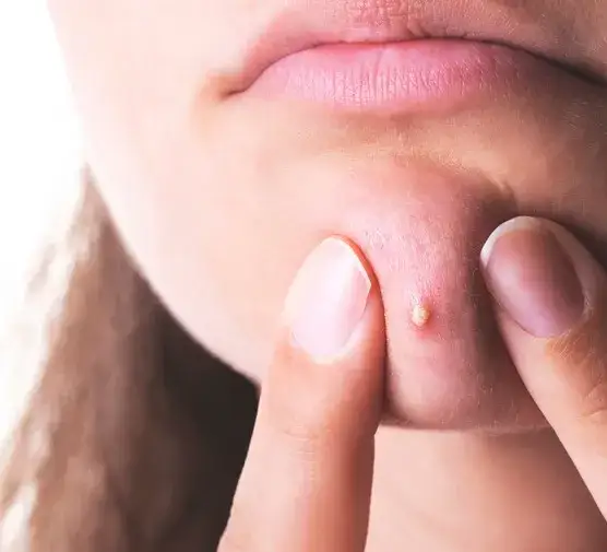 Zdjęcie Jak szybko zagoić ranę po pryszczu - skuteczne metody na blizny