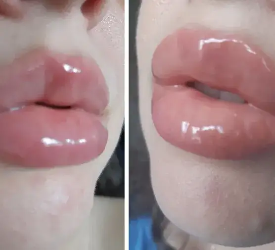 Zdjęcie Czy można pić alkohol po powiększaniu ust? Dowiedz się o ryzyku.