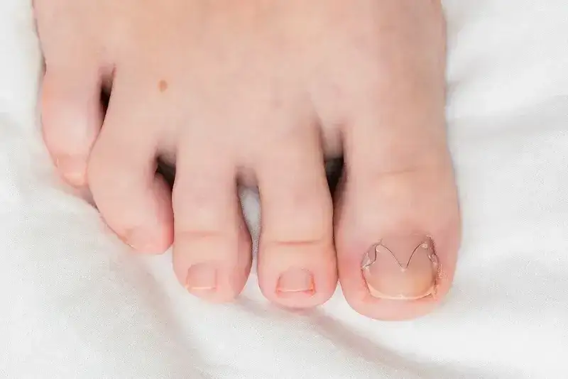 Zdjęcie Jak założyć klamrę na wrastający paznokieć i uniknąć bólu