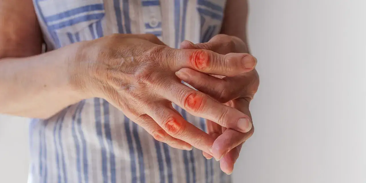 Zdjęcie Seronegatywne zapalenie stawów: objawy i opcje leczenia.