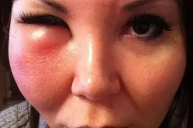 Zdjęcie Skutki uboczne mezoterapii mikroigłowej: jakie ryzyka są realne?