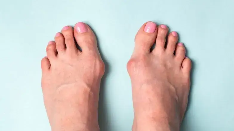 Zdjęcie Jak zapobiegać haluksom i uniknąć bólu stóp na co dzień