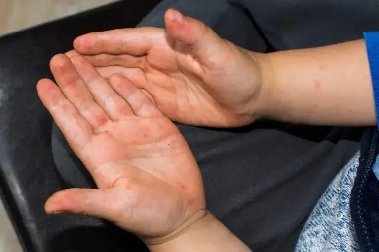 Zdjęcie Kiedy dziecko może wrócić do przedszkola po bostonce? Sprawdź teraz