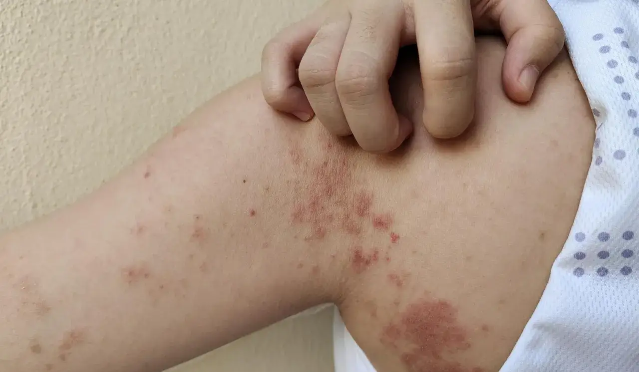 Zdjęcie Objawy ugryzienia pająka: jak rozpoznać niebezpieczne symptomy