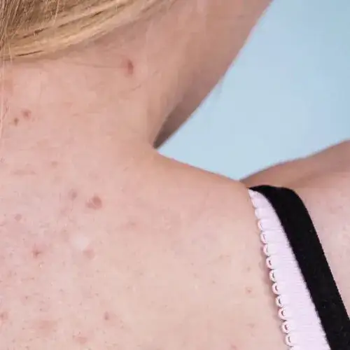 Zdjęcie Dlaczego mam pryszcze na plecach? Odkryj przyczyny i skuteczne metody leczenia