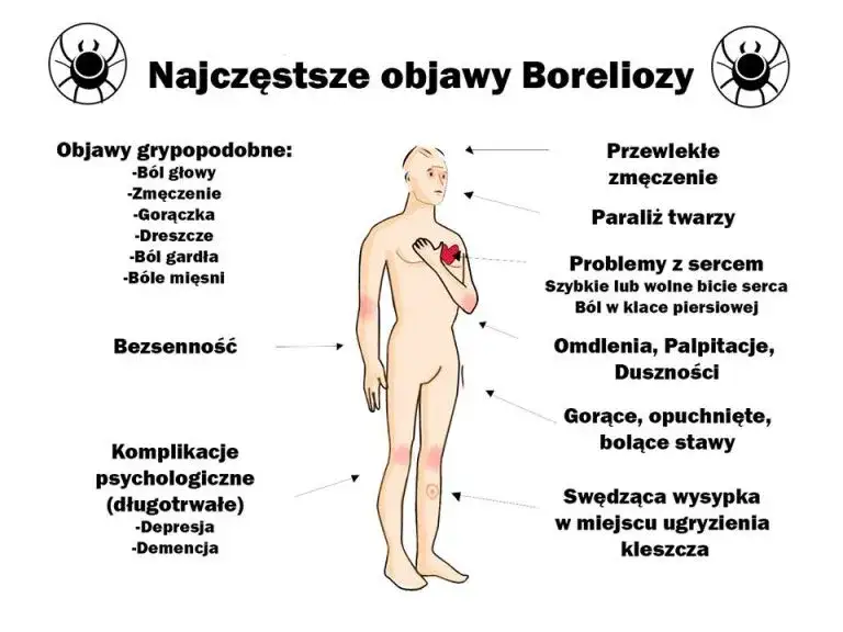 Zdjęcie Ile kosztuje badania na boreliozę: wszystkie ceny diagnostyki w Polsce