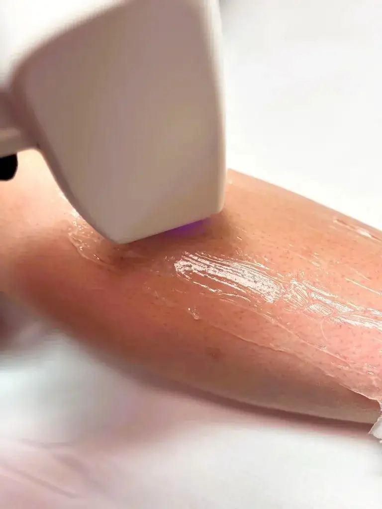 Zdjęcie Epilacja laserowa jaki laser wybrać dla najlepszych efektów?