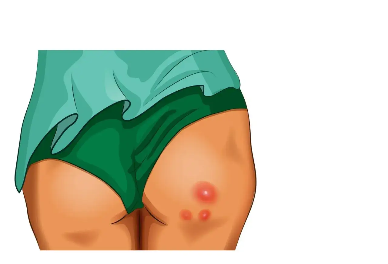 Zdjęcie Skuteczne maści na czyraki bez recepty - ulga i szybkie gojenie