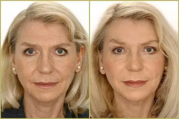 Zdjęcie Ile kosztuje kwas hialuronowy na twarz? Ceny zabiegów w Polsce