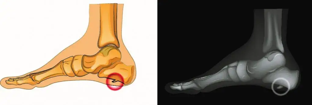 Zdjęcie Ostroga piętowa przyczyny: poznaj czynniki, które mogą cię boleć