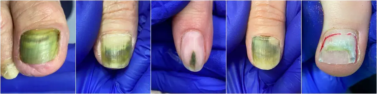 Zdjęcie Zielona bakteria na paznokciu - jak uniknąć zakażenia i leczyć objawy
