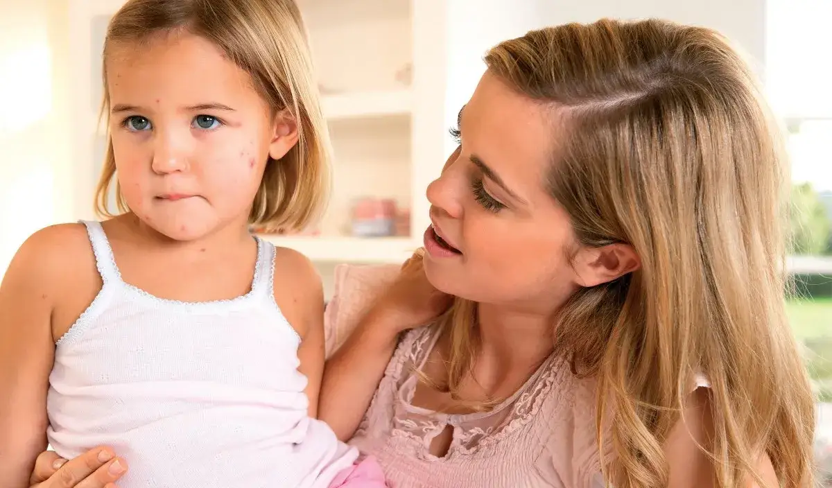 Zdjęcie Czy rodzeństwo dziecka z ospą może chodzić do przedszkola? Ważne informacje