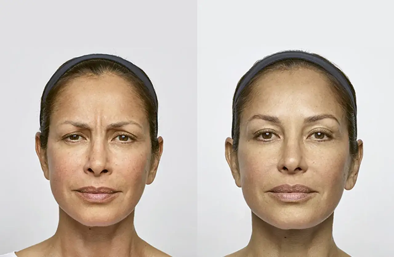 Zdjęcie Jak przeliczyć jednostki Azzalure na Botox dla skutecznych efektów