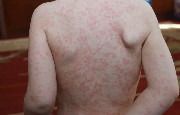 Zdjęcie Mononukleoza u dzieci objawy – na co zwrócić uwagę i jak leczyć?