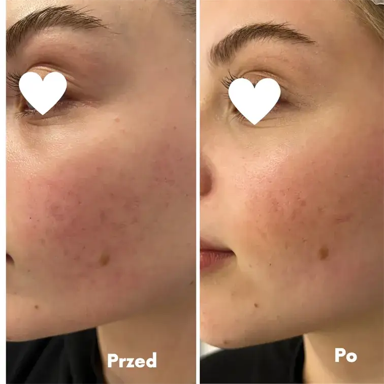 Zdjęcie Jak długo goi się skóra po laserze frakcyjnym? Czas regeneracji