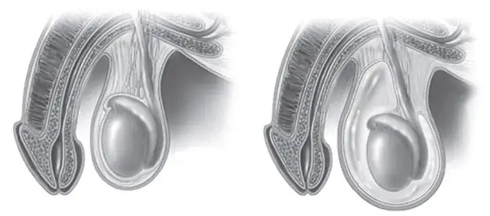 Zdjęcie Elewacja moszny: wszystko co musisz wiedzieć o zabiegu chirurgicznym