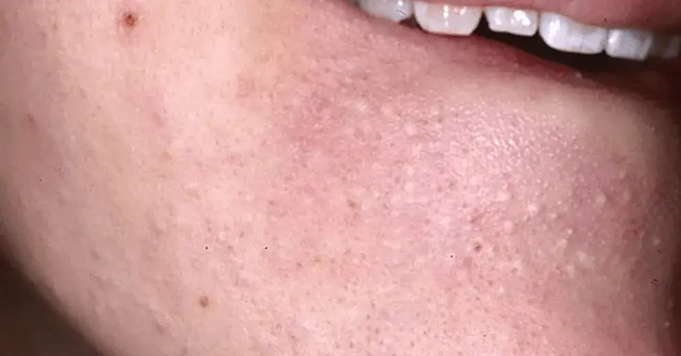 Zdjęcie Pryszcze na brodzie i żuchwie: przyczyny, leczenie i jak się ich pozbyć