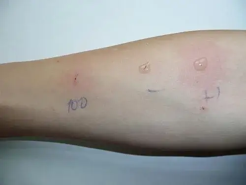Zdjęcie Na ile przed testami alergicznymi odstawić leki, aby uzyskać dokładne wyniki?
