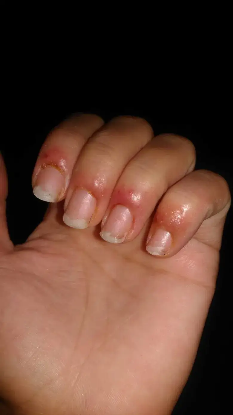 Zdjęcie Uczulenie na hybrydę - jak rozpoznać objawy i co robić?