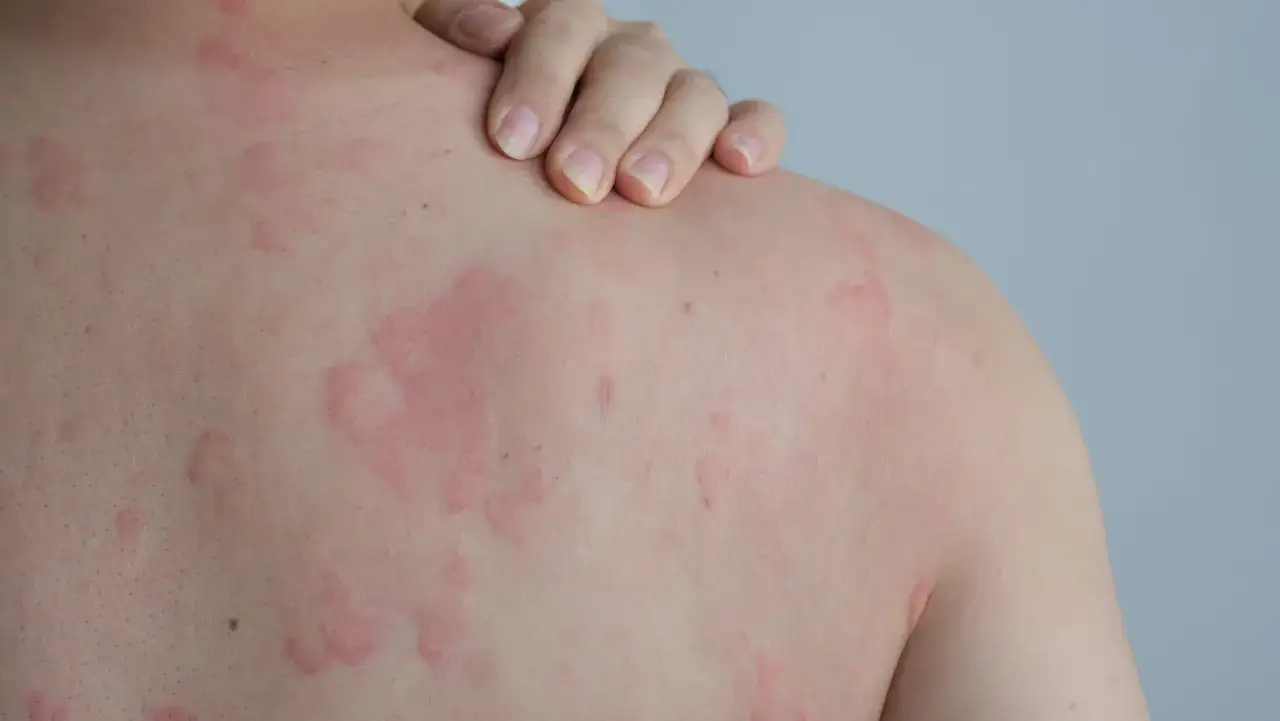 Zdjęcie Alergia na pyłki objawy skórne: jak je rozpoznać i leczyć