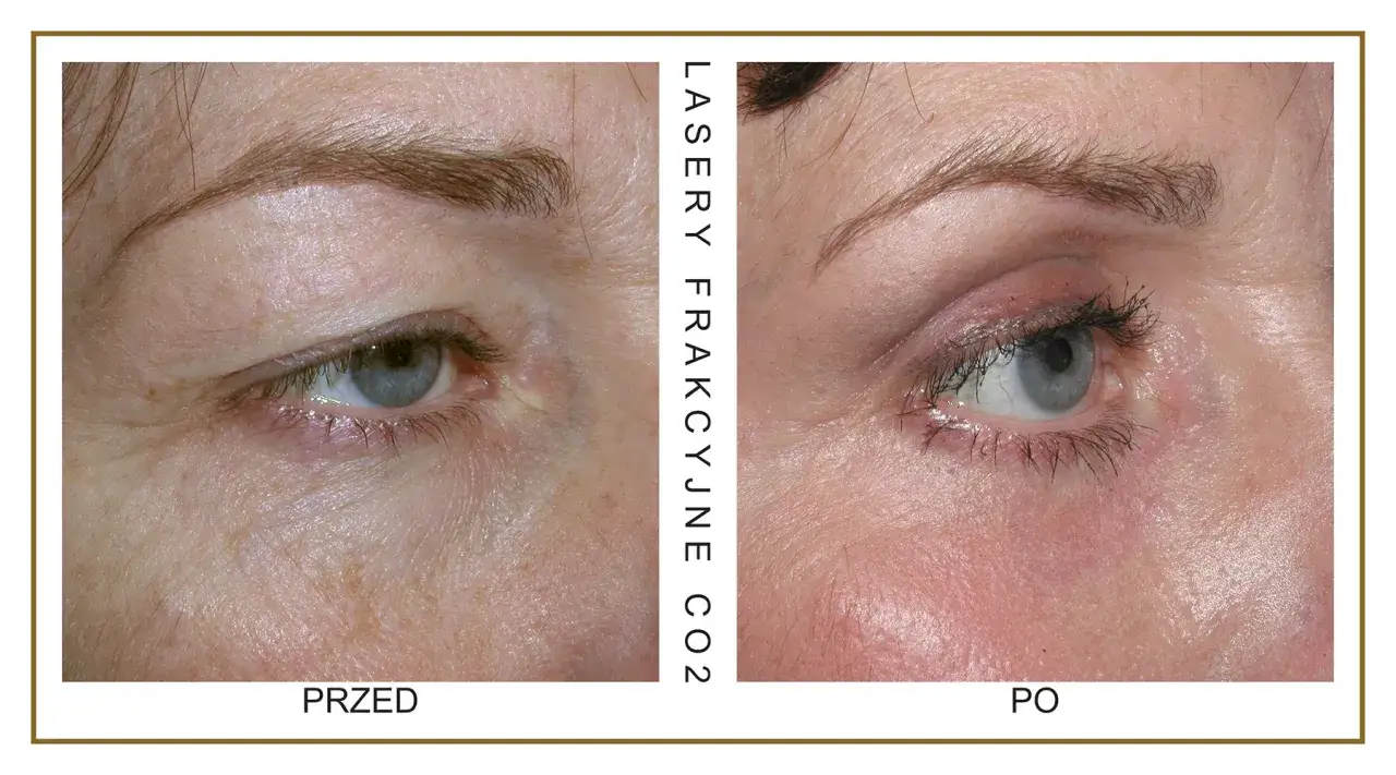 Zdjęcie Laser frakcyjny CO2 – co to jest i jak może odmłodzić Twoją skórę