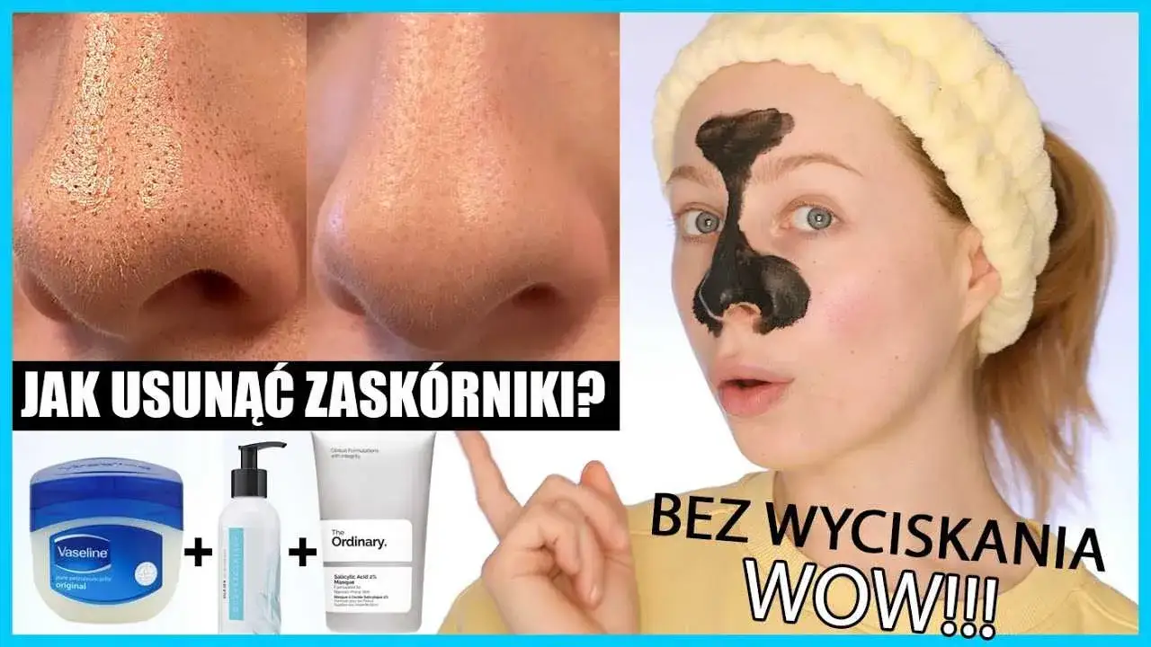 Zdjęcie Skuteczne sposoby na pozbycie się pryszcza w nosie bez bólu