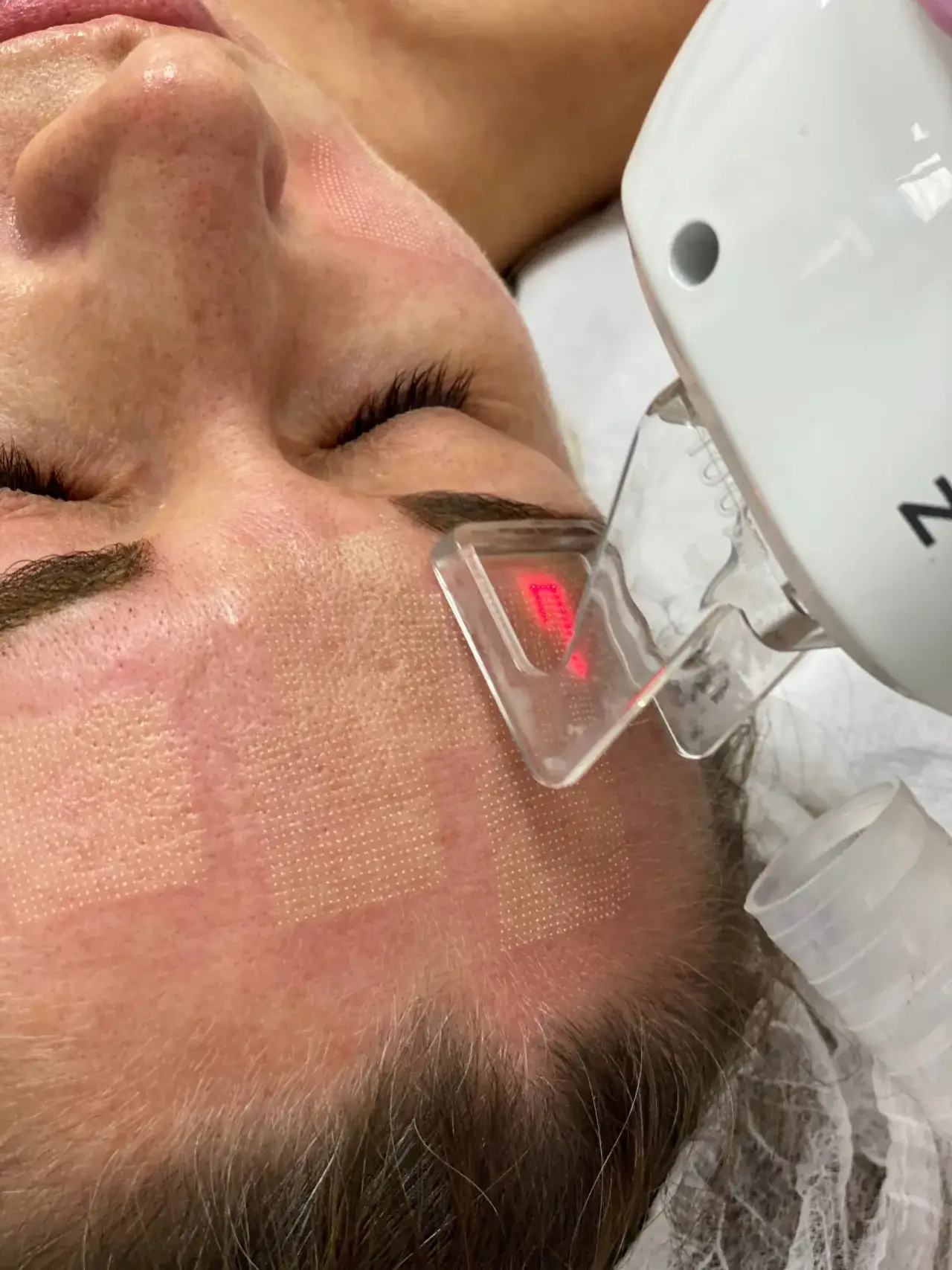 Zdjęcie Jak się przygotować do laseru frakcyjnego, aby uniknąć problemów?