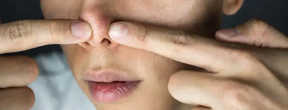 Zdjęcie Jak usunąć pryszcza z nosa? Skuteczne metody i porady na teraz