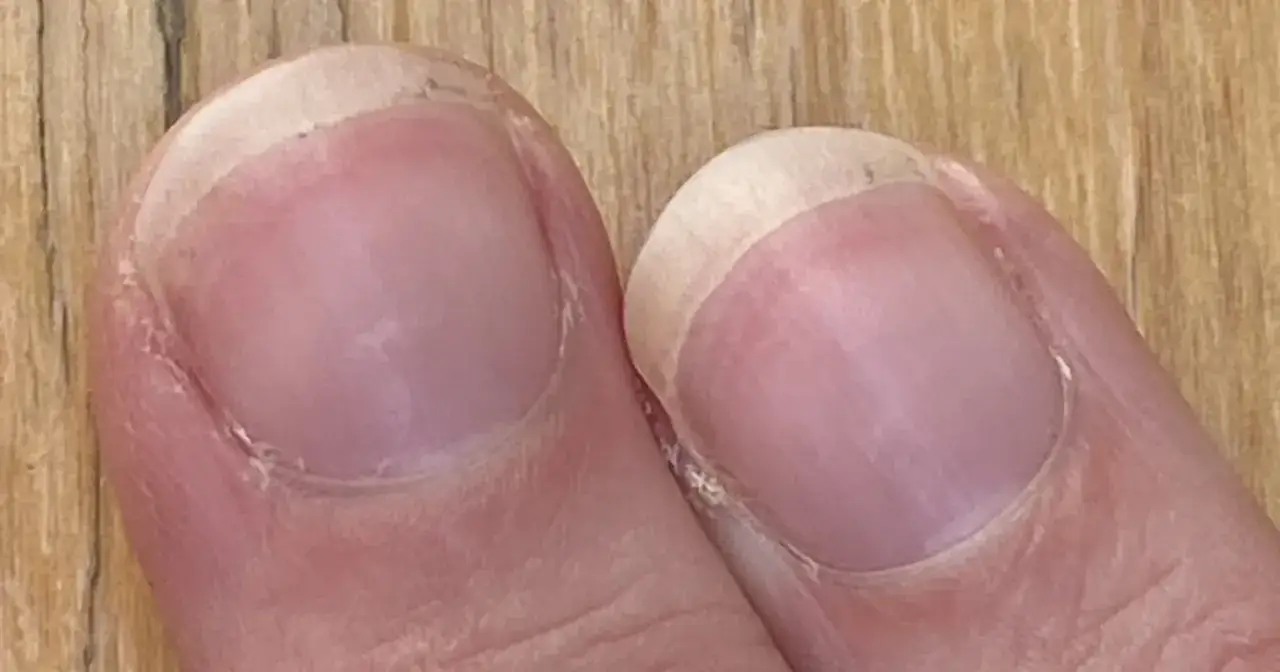 Zdjęcie Paski na paznokciach co oznaczają – objawy, które mogą zaskoczyć