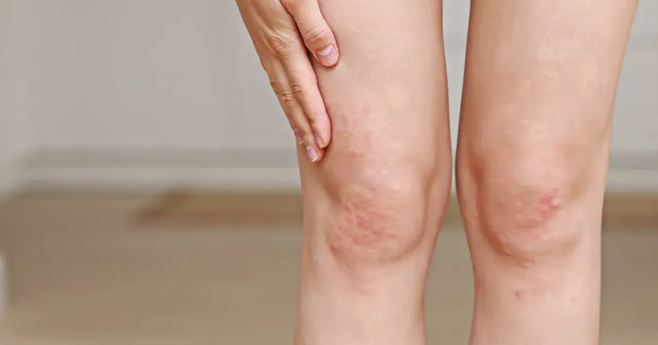 Zdjęcie Objawy wysokiego cholesterolu, które mogą zaskoczyć każdego z nas