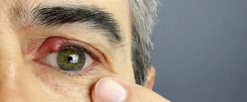 Zdjęcie Jakie leki na jęczmień na oku skutecznie złagodzą objawy?