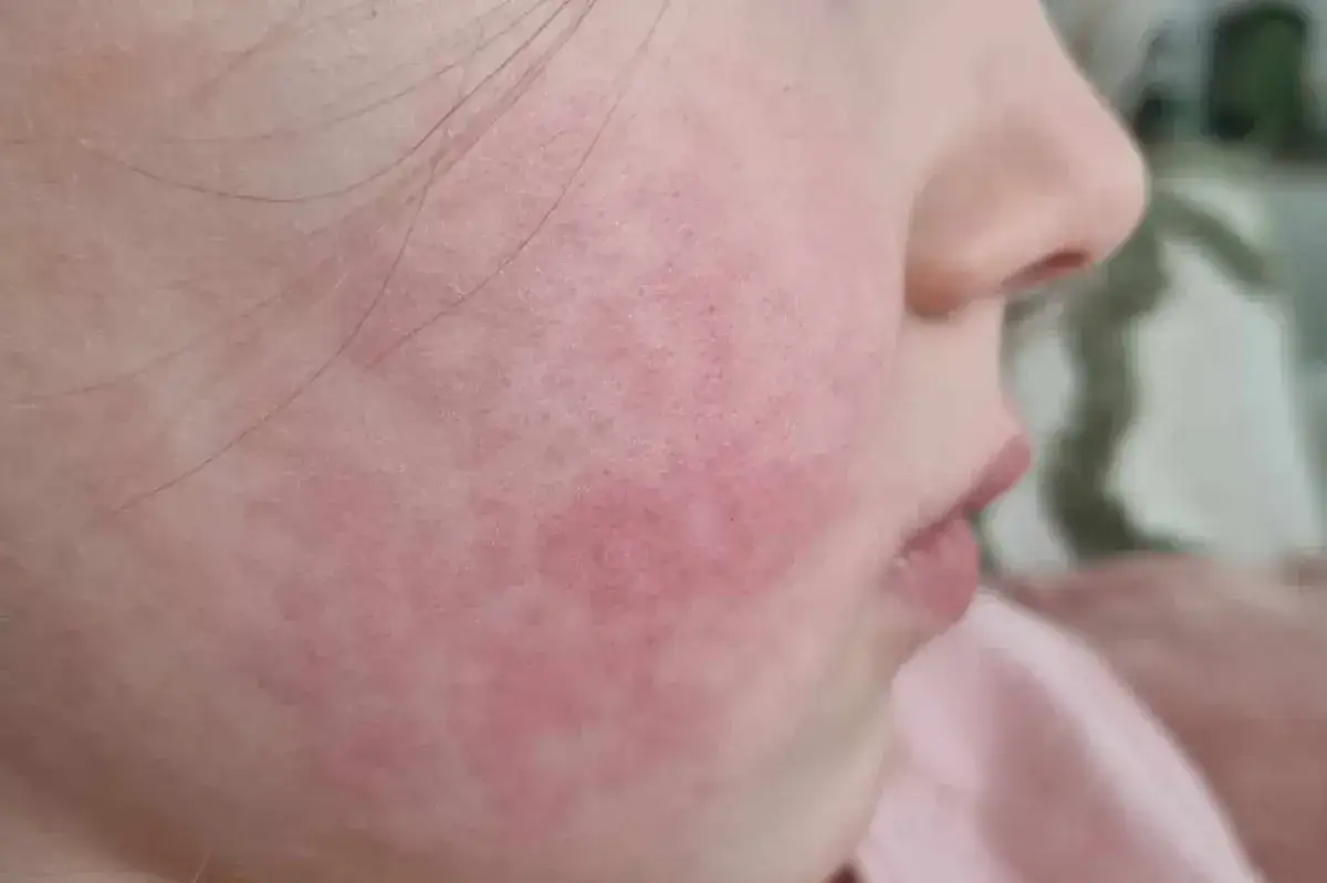 Zdjęcie Rumień zakaźny kiedy do przedszkola? Kluczowe informacje dla rodziców