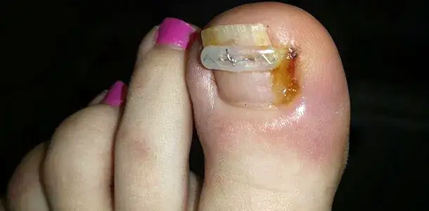 Zdjęcie Jak długo nosić klamry na wrastające paznokcie? Czas leczenia i oczekiwania